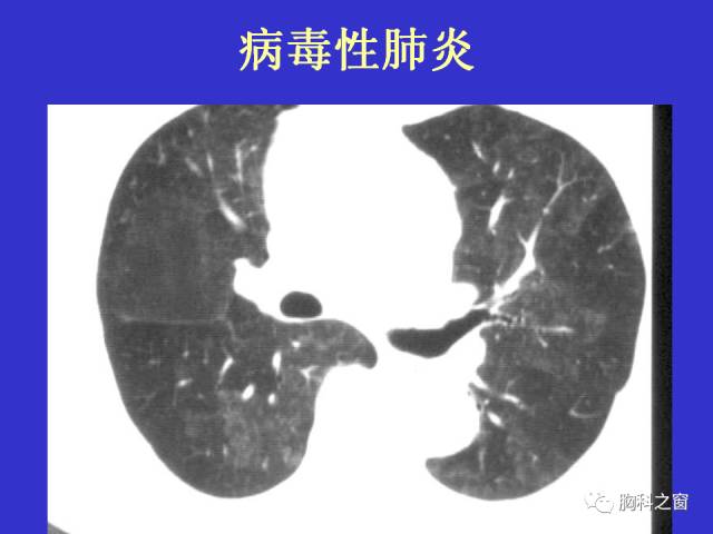 【PPT】肺部感染性疾病的CT