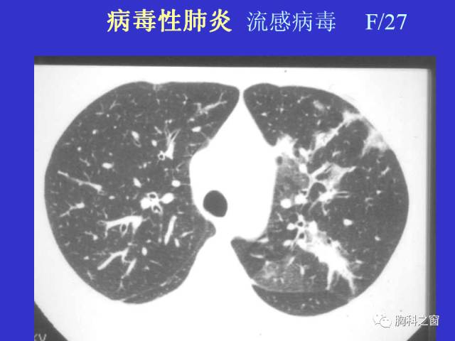 【PPT】肺部感染性疾病的CT