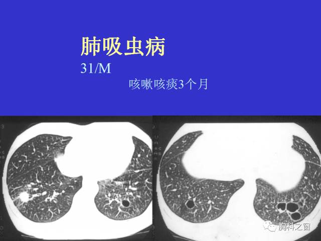 【PPT】肺部感染性疾病的CT