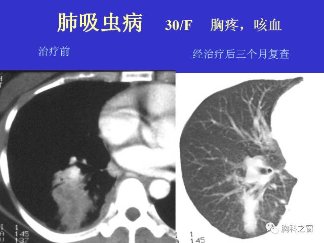 【PPT】肺部感染性疾病的CT