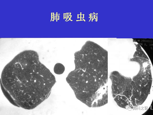 【PPT】肺部感染性疾病的CT