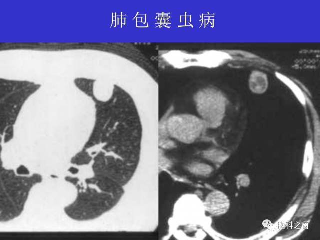 【PPT】肺部感染性疾病的CT