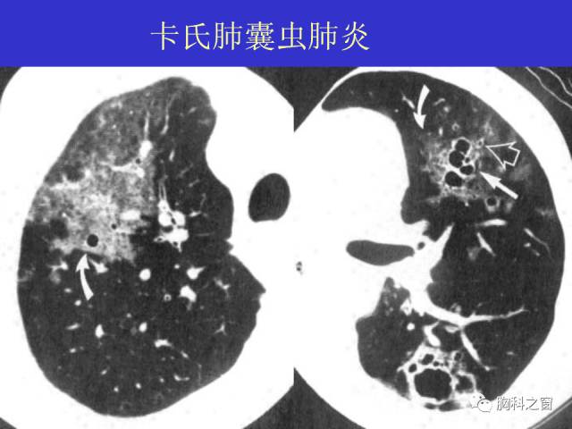 【PPT】肺部感染性疾病的CT