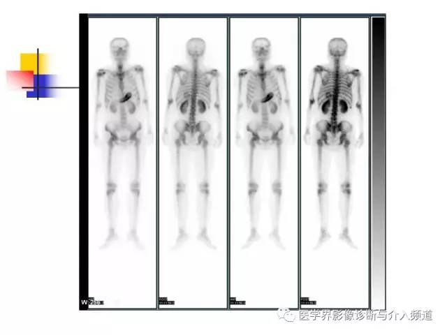 【病例】多发性骨髓瘤1例CT影像表现