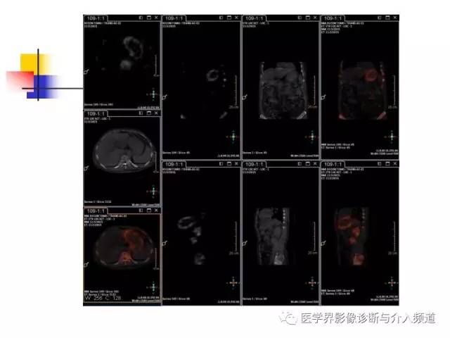 【病例】多发性骨髓瘤1例CT影像表现