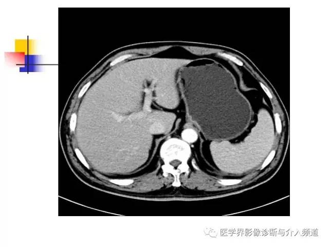 【病例】多发性骨髓瘤1例CT影像表现