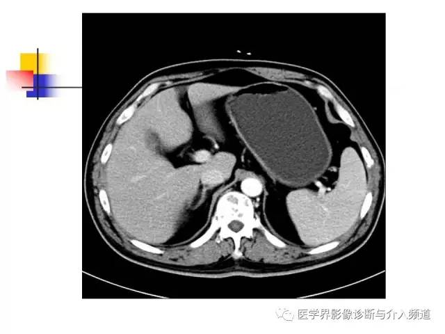 【病例】多发性骨髓瘤1例CT影像表现