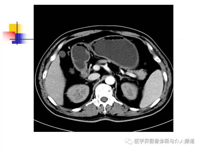 【病例】多发性骨髓瘤1例CT影像表现