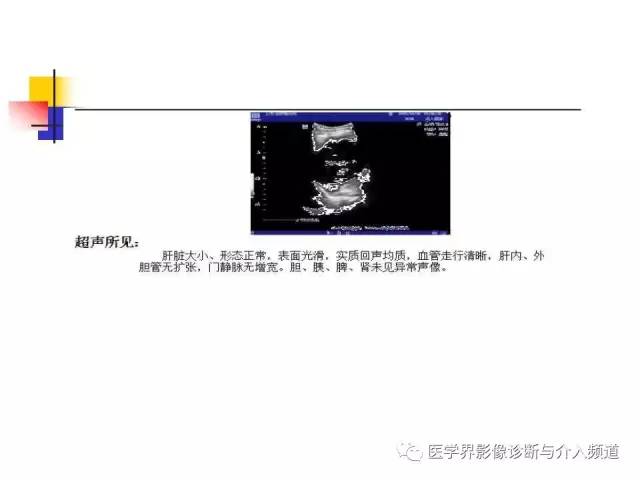 【病例】多发性骨髓瘤1例CT影像表现
