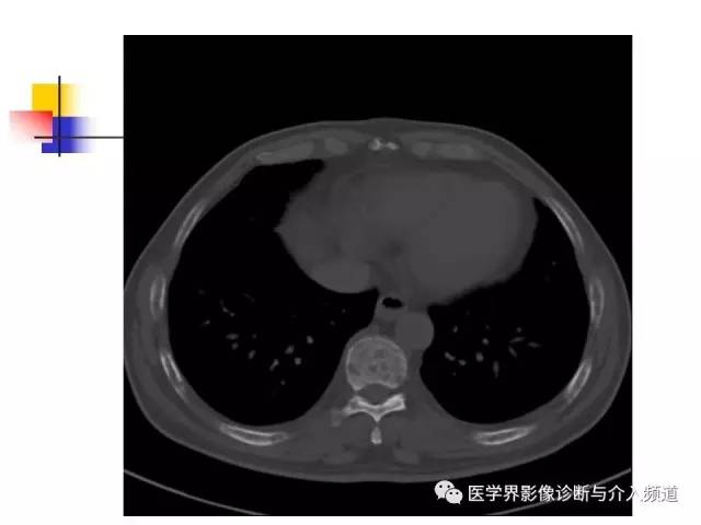 【病例】多发性骨髓瘤1例CT影像表现