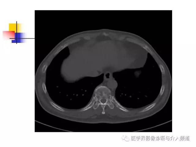 【病例】多发性骨髓瘤1例CT影像表现