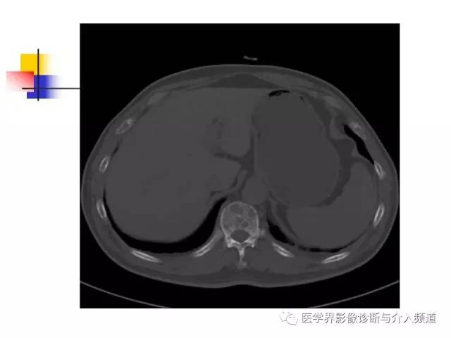 【病例】多发性骨髓瘤1例CT影像表现