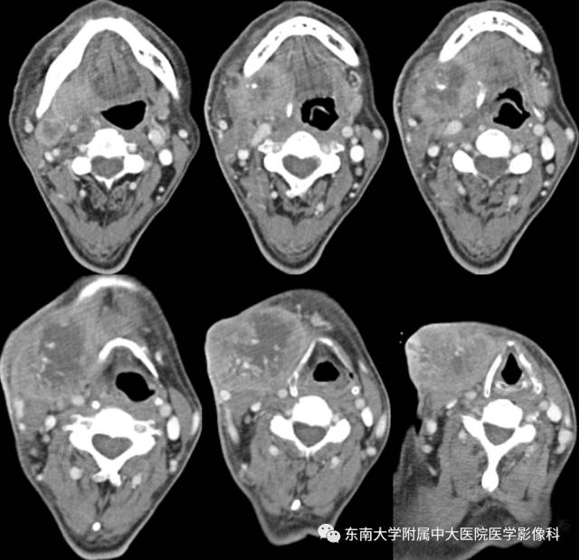 【病例】颌下腺病变6例CT随访 【病例】颌下腺病变6例CT随访