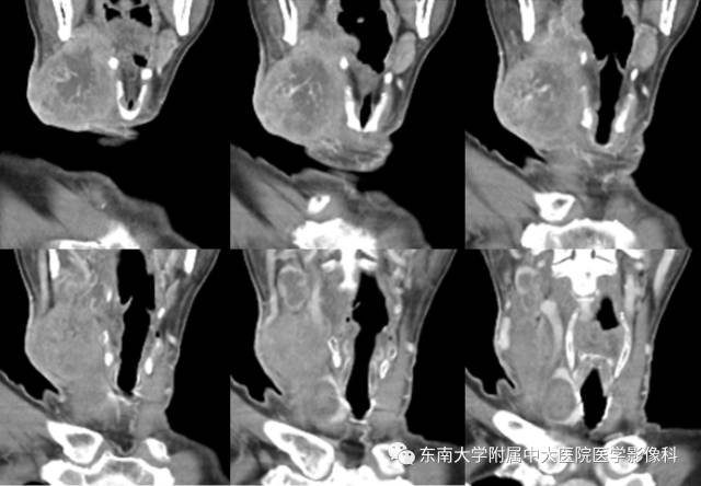 【病例】颌下腺病变6例CT随访 【病例】颌下腺病变6例CT随访