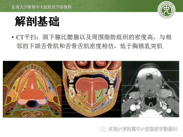【病例】颌下腺病变6例CT随访 【病例】颌下腺病变6例CT随访