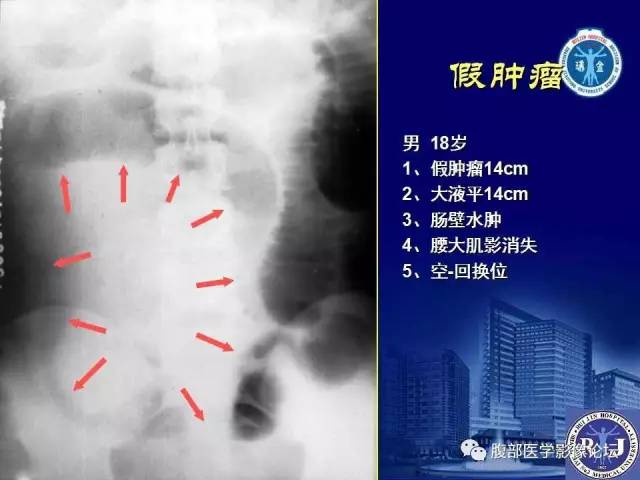 【PPT】绞窄性肠梗阻CT诊断