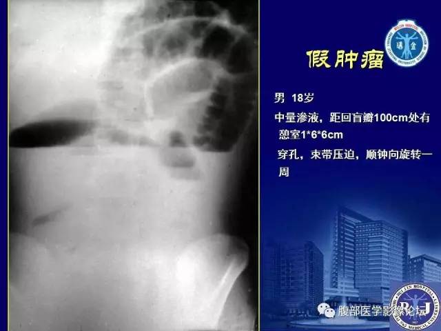 【PPT】绞窄性肠梗阻CT诊断