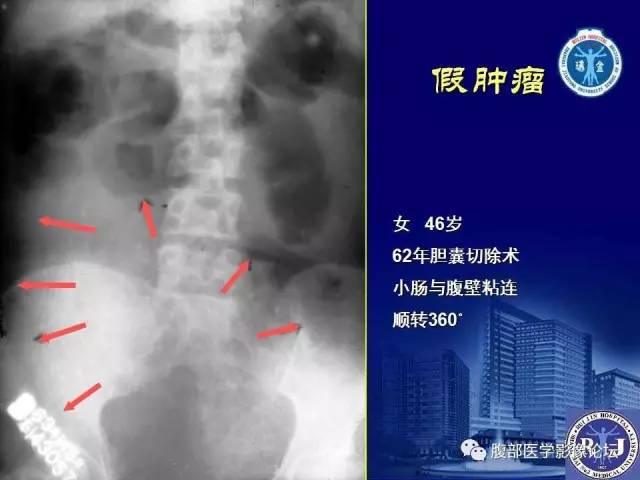 【PPT】绞窄性肠梗阻CT诊断