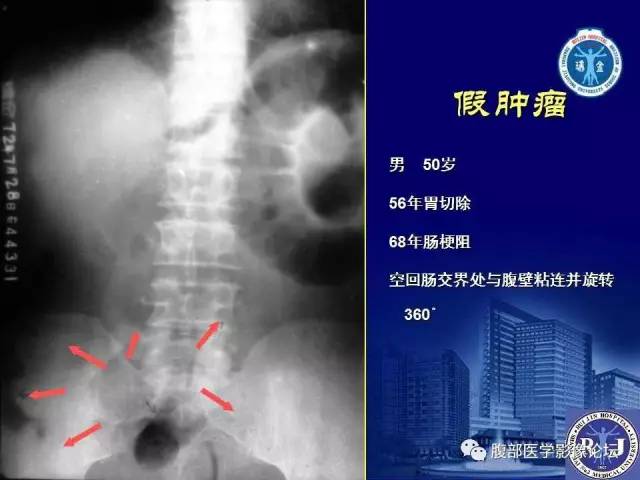 【PPT】绞窄性肠梗阻CT诊断