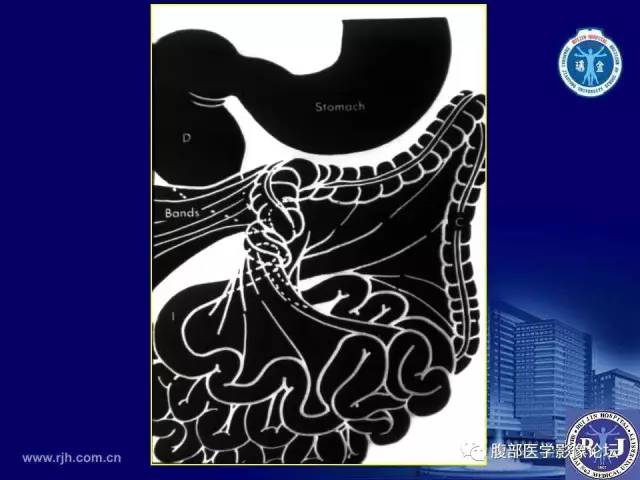 【PPT】绞窄性肠梗阻CT诊断