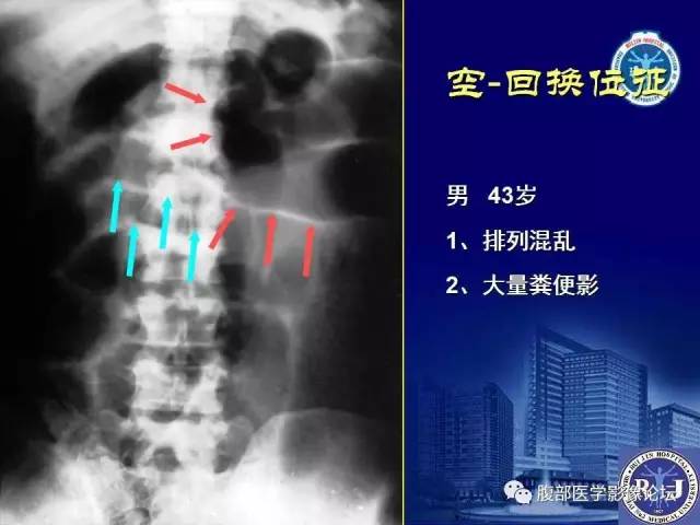 【PPT】绞窄性肠梗阻CT诊断