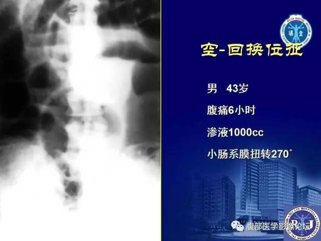 【PPT】绞窄性肠梗阻CT诊断