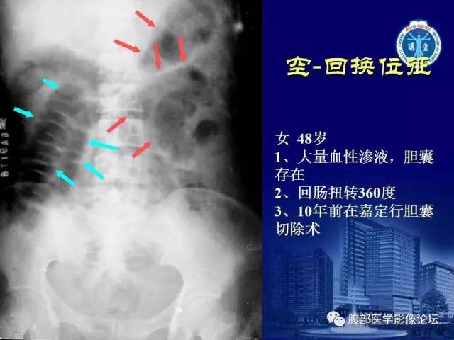 【PPT】绞窄性肠梗阻CT诊断