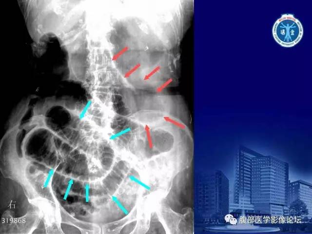 【PPT】绞窄性肠梗阻CT诊断
