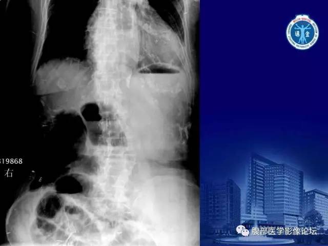 【PPT】绞窄性肠梗阻CT诊断