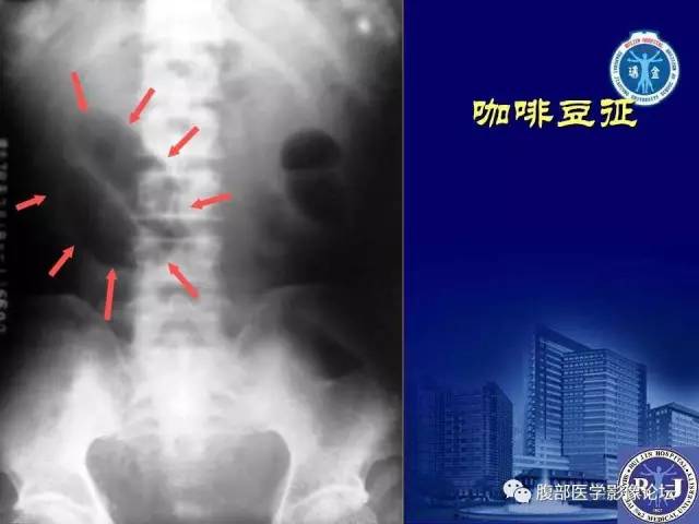 【PPT】绞窄性肠梗阻CT诊断