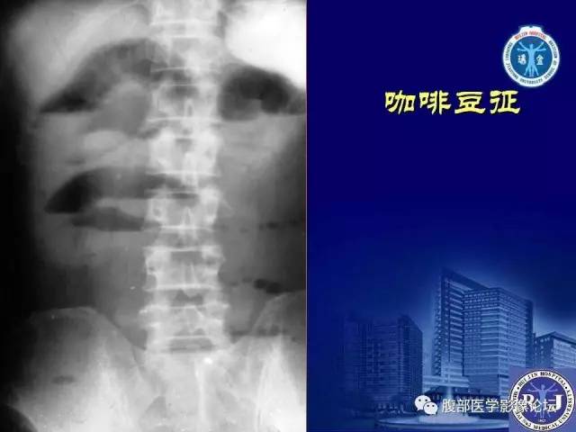 【PPT】绞窄性肠梗阻CT诊断