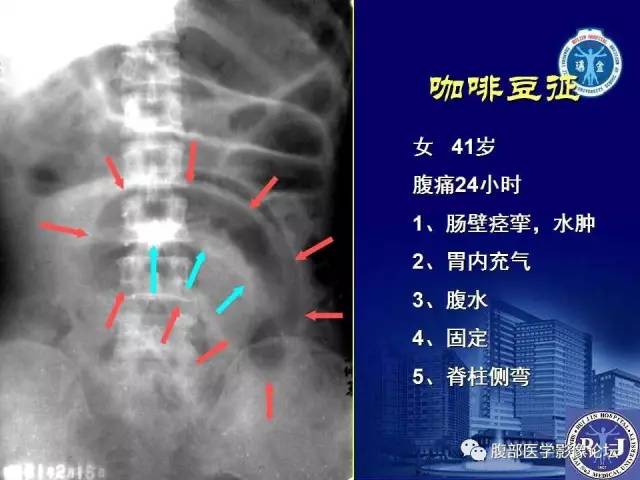 【PPT】绞窄性肠梗阻CT诊断