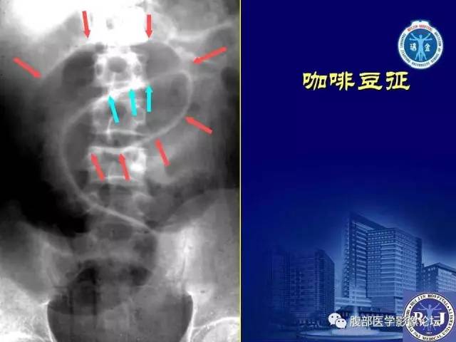 【PPT】绞窄性肠梗阻CT诊断