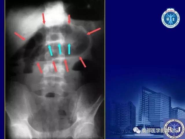 【PPT】绞窄性肠梗阻CT诊断