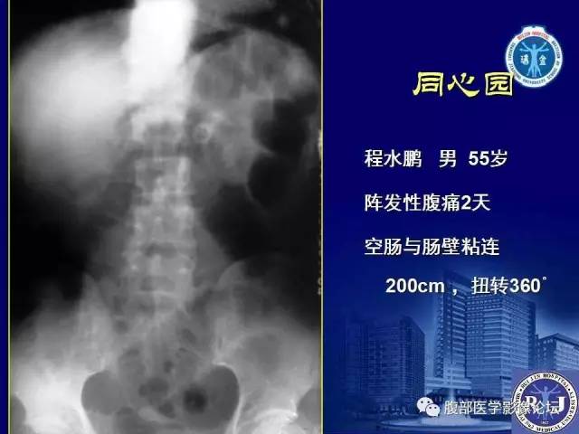 【PPT】绞窄性肠梗阻CT诊断