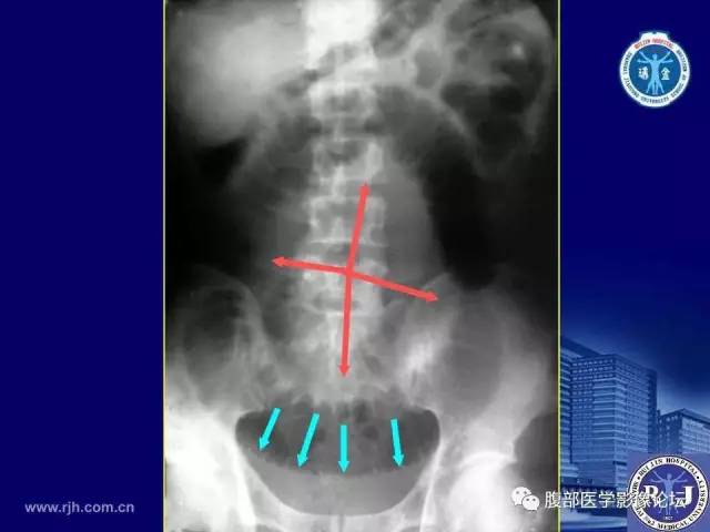 【PPT】绞窄性肠梗阻CT诊断