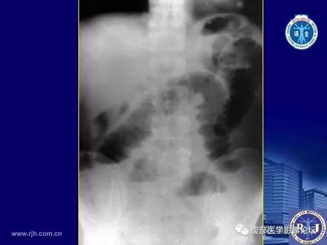 【PPT】绞窄性肠梗阻CT诊断