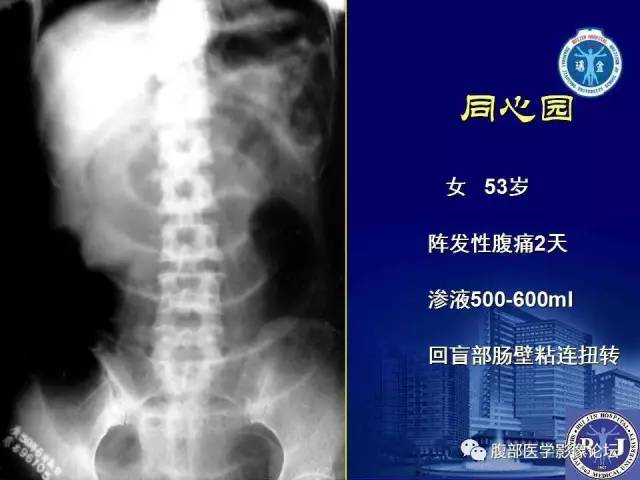 【PPT】绞窄性肠梗阻CT诊断