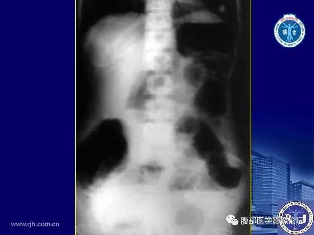 【PPT】绞窄性肠梗阻CT诊断