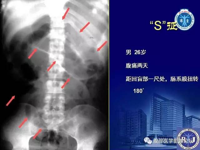 【PPT】绞窄性肠梗阻CT诊断