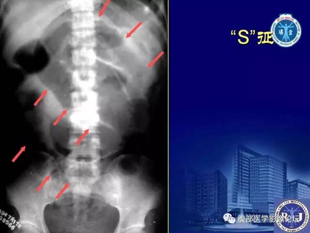 【PPT】绞窄性肠梗阻CT诊断