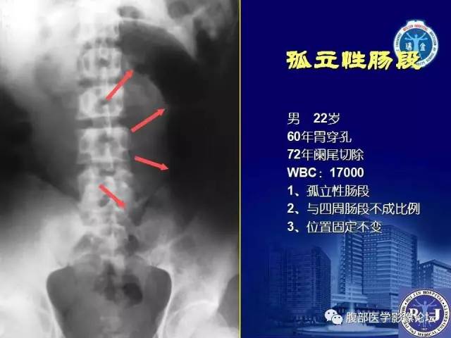 【PPT】绞窄性肠梗阻CT诊断