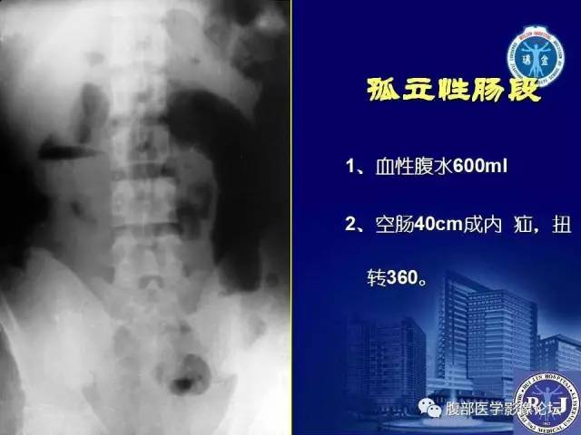 【PPT】绞窄性肠梗阻CT诊断