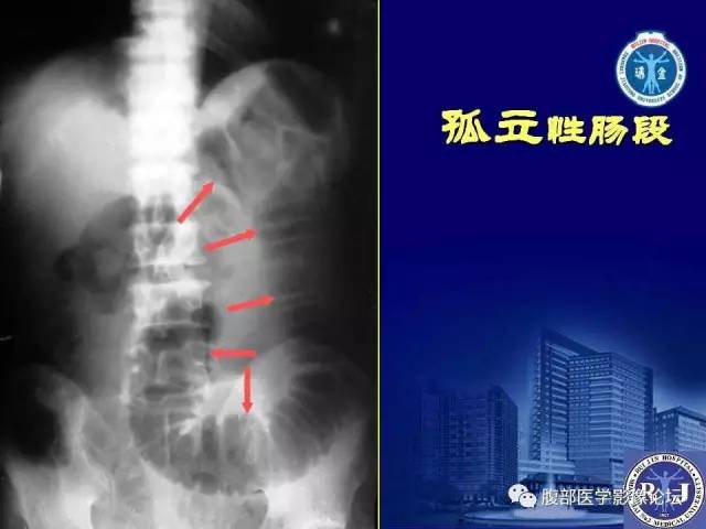 【PPT】绞窄性肠梗阻CT诊断