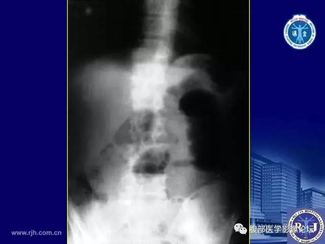 【PPT】绞窄性肠梗阻CT诊断