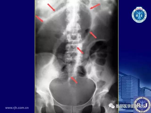 【PPT】绞窄性肠梗阻CT诊断