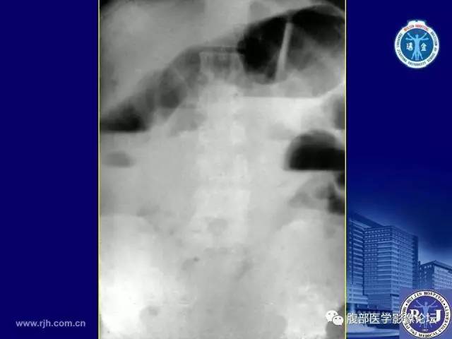 【PPT】绞窄性肠梗阻CT诊断
