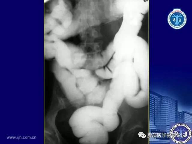 【PPT】绞窄性肠梗阻CT诊断