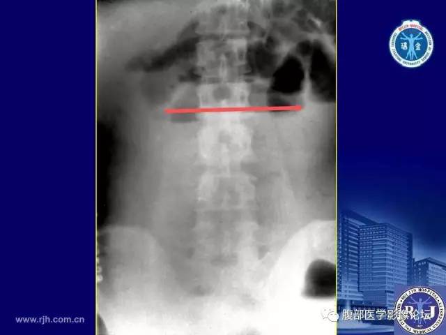 【PPT】绞窄性肠梗阻CT诊断