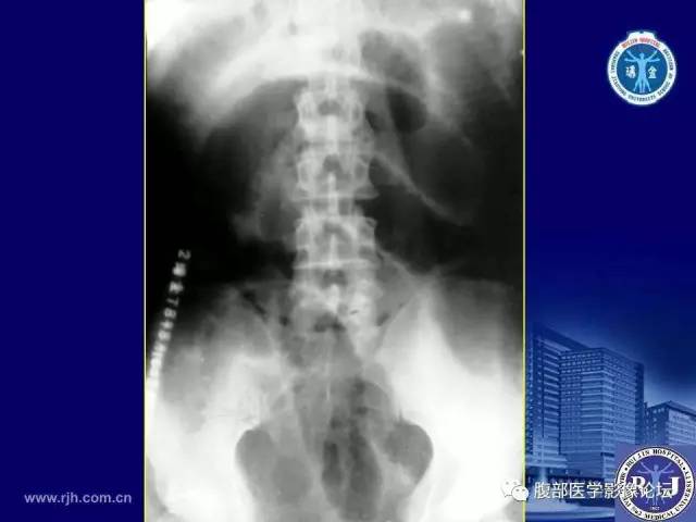 【PPT】绞窄性肠梗阻CT诊断